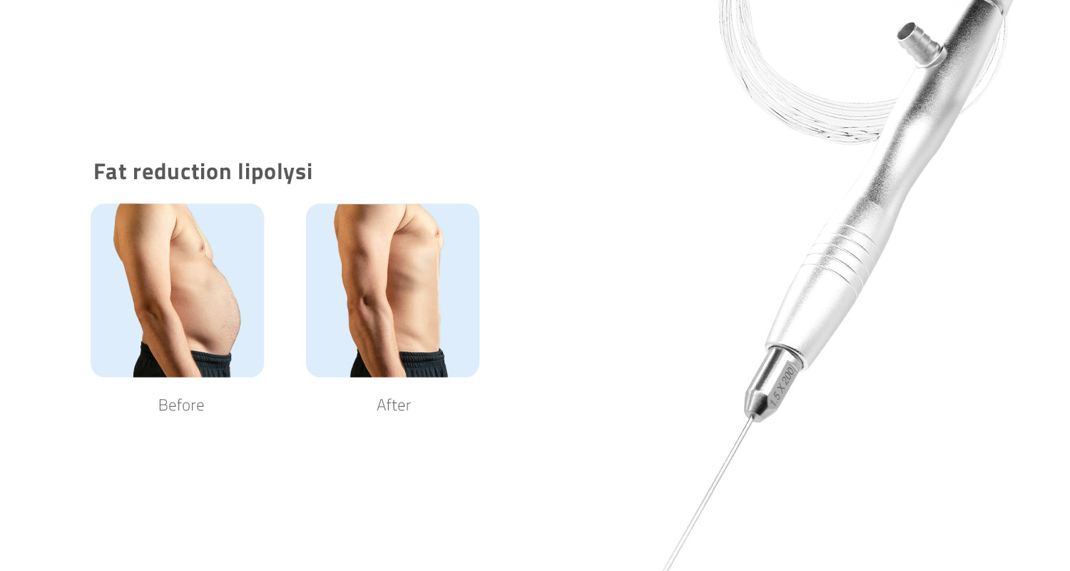 Photon-ENDOLIFT1470nm 1470 nm Laser Platform product detail 6